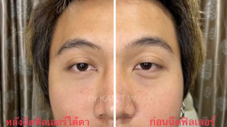 แก้ปัญหาใต้ตาคล้ำ ร่องตาลึก ด้วยฟิลเลอร์ใต้ตา